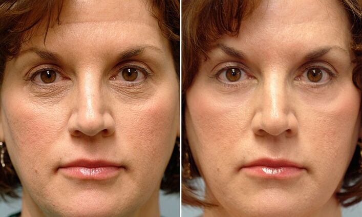Gesicht vor und nach der fraktionierten Laserverjüngung